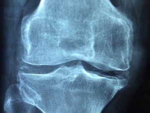 Borax gegen Arthrose umd Qsteoporose